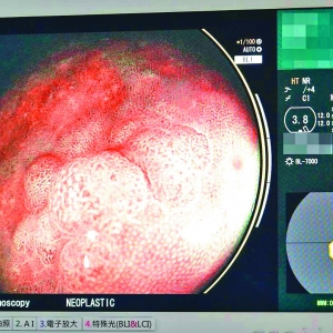 AI內視鏡揪息肉 發現大腸癌